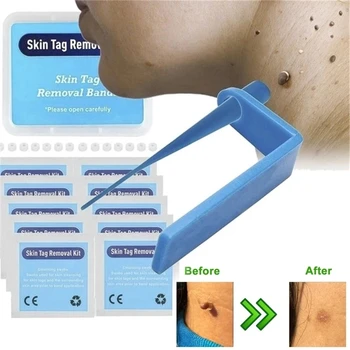 Médico micro pele tag remover a Pele Mole Verruga Removedor de Micro Banda Tag Pele de Remoção Com o Kit de Limpeza com Cotonetes Adultos Mole Cuidado da Cara